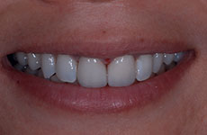 teeth after